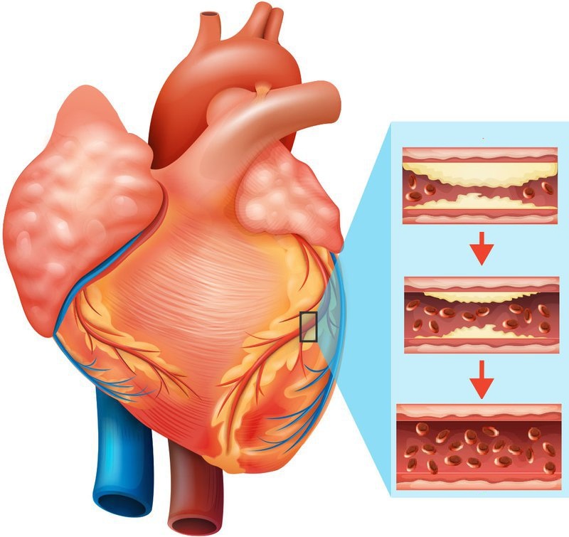 Bỏ hút thuốc sau 20 năm sẽ giúp giảm nguy cơ mắc bệnh mạch vành